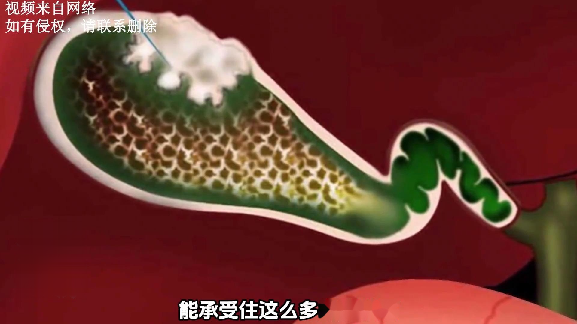 不吃早餐长结石(不吃早餐容易结石) 不吃早餐长结石(不吃早餐容易结石)